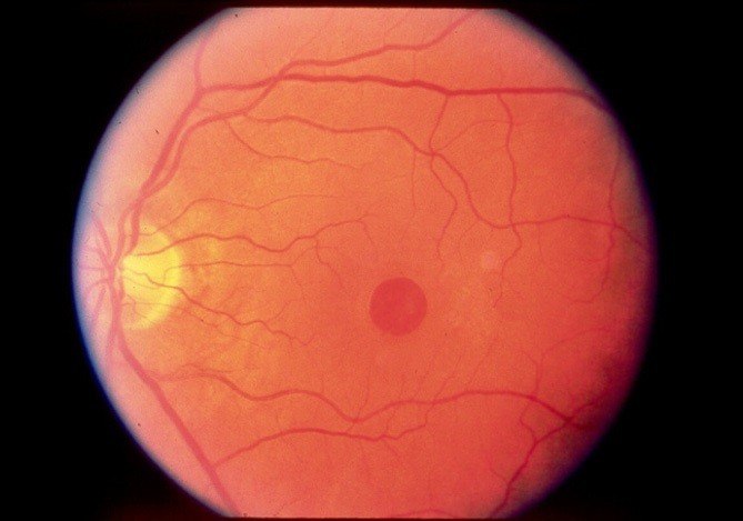 Agujero macular en fondo de ojo