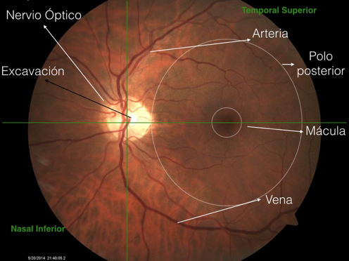 Imagen de agujero macular