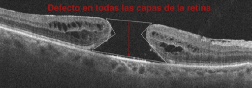 Tomografía de retina con agujero macular — forma de reloj de arena