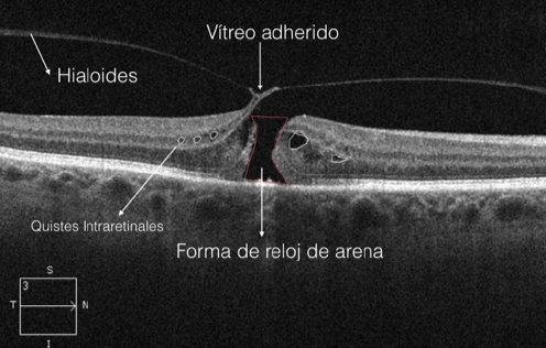 Gel vítreo adherido traccionando y generando agujero macular