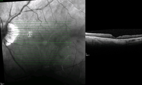 OCT postoperatorio de agujero macular resuelto