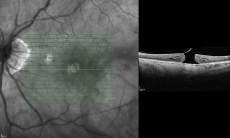 OCT preoperatorio de agujero macular
